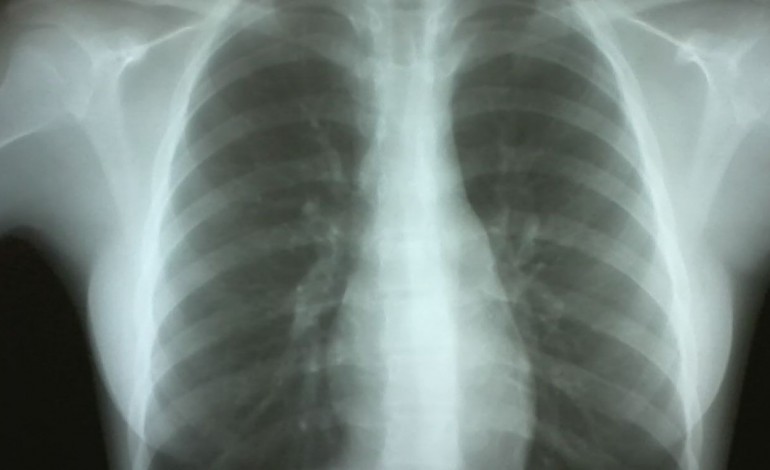 taxa-de-incidencia-da-tuberculose-no-centro-e-a-mais-baixa-do-pais-8339